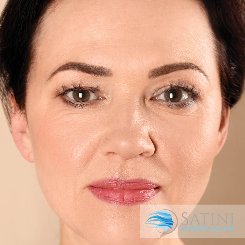 Micro Botox Facial | Satini Cosmetic Clinic