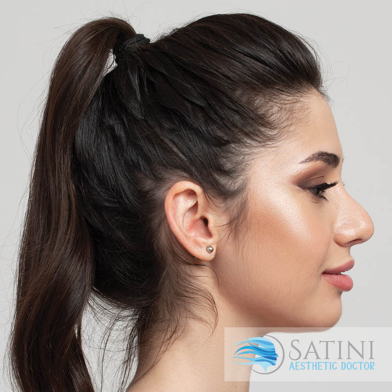 Dermal filler for jawline enhancement