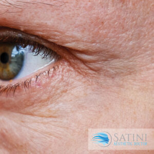 Wrinkles around the eyes after Botox treatment- Botox clinic near me
