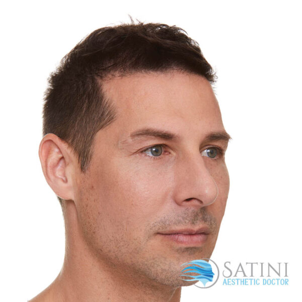 After Dermal Filler For Men-Botox Clinic Near Me-Christchurch Botox