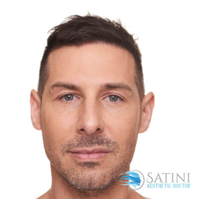 After Dermal Filler For Men-Botox clinic near me-Christchurch Botox