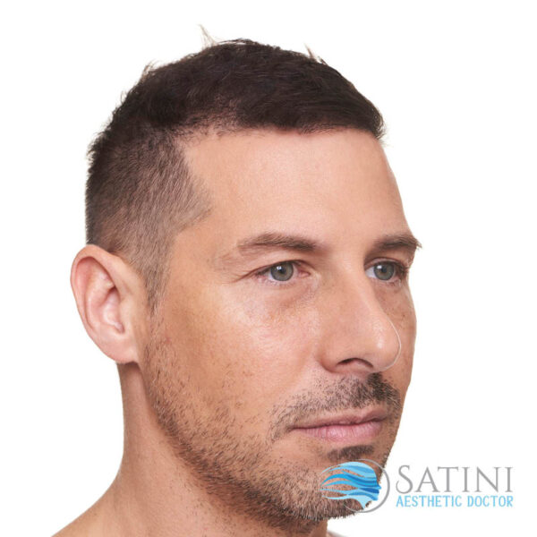 Before Dermal Filler For Men-Botox Clinic Near Me-Christchurch Botox