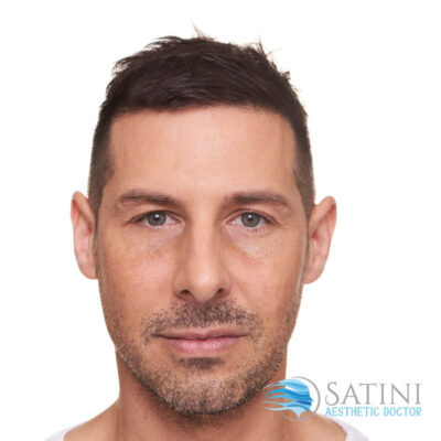 Before Dermal Filler Men-Botox clinic near me-Christchurch Botox