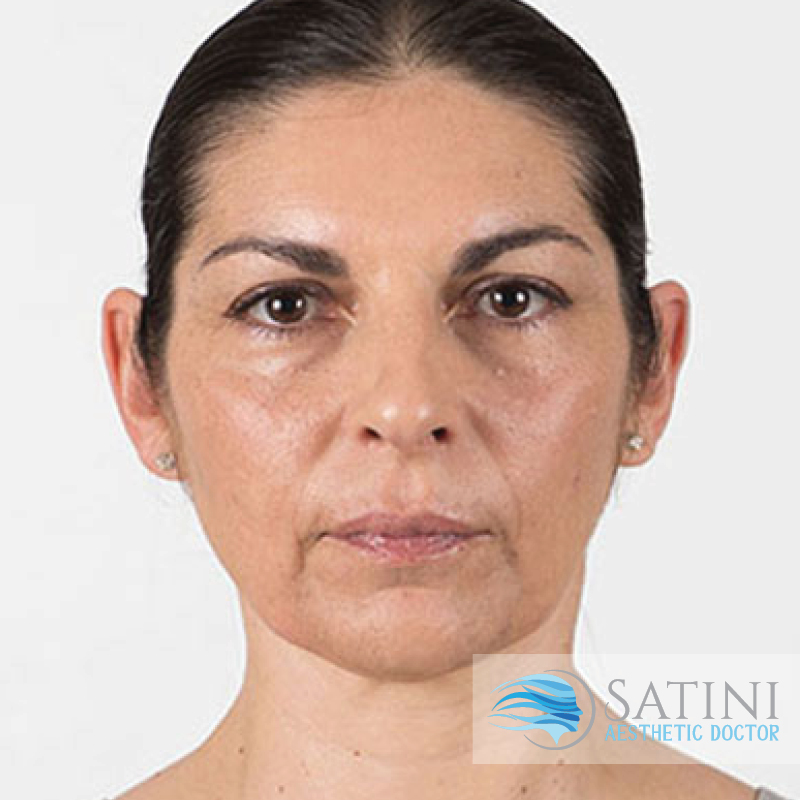 Before Dermal Filler-Botox Clinic Near Me Christchurch