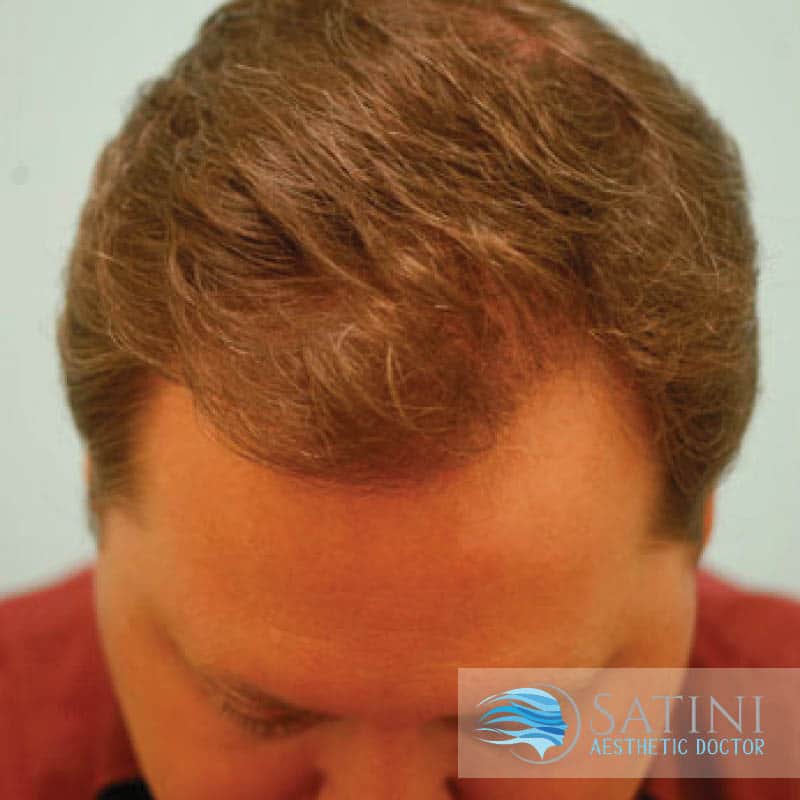 After Combination treatment for hair loss-Finasteride-Redensyl-Saw Palmetto-Laser-Hair Loss Clinic Near Me-Christchurch