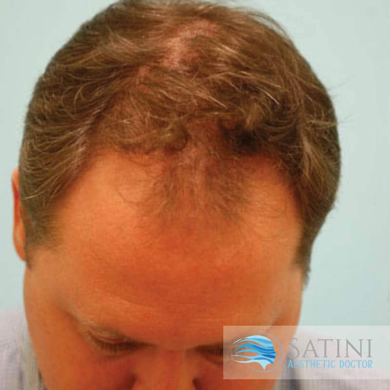 Hair Loss before combination treatment with finasteride, laser, supplements and high quality shampoo-Hair loss clinic Near Me-Christchurch