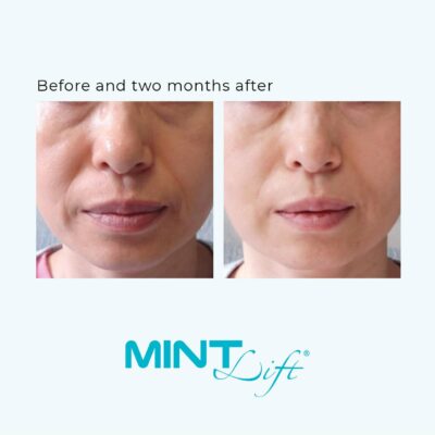 MINT Thread Lift Before And After