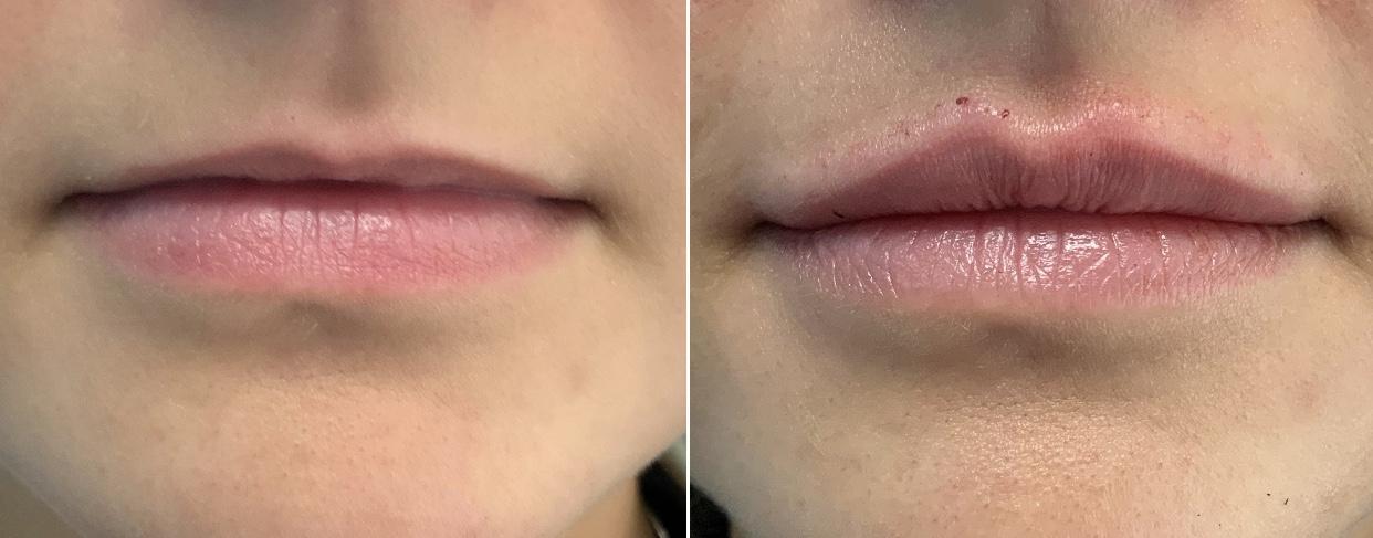 MINT Thread Lip Enhancement