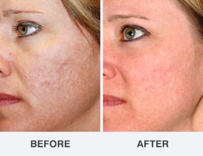 Before and after MINT Threads for acne scars-Botox Clinic Christchurch-Botox Near Me
