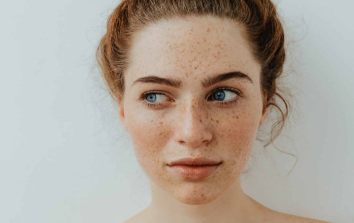 Cosmelan Anti-Pigmentation Program-Dark Spots-uneven skin texture-melasma