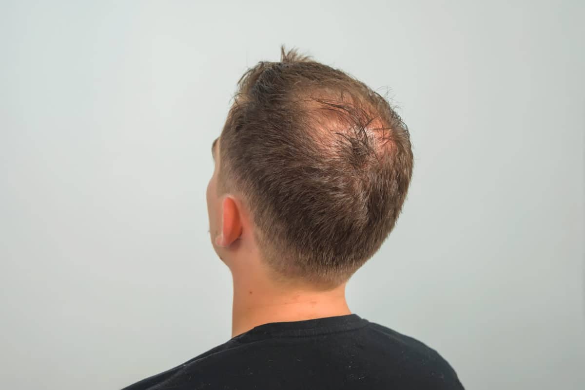 Common Hair Loss Types in Men | Satini Cosmetic Clinic