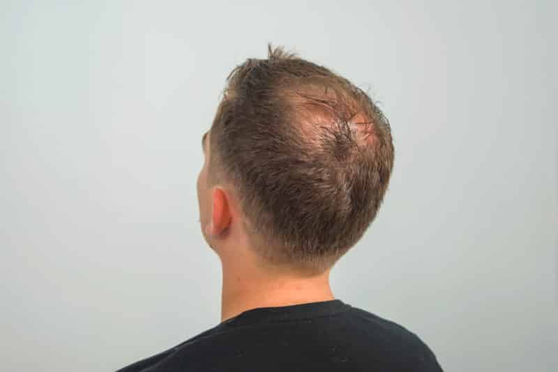 Male Pattern Baldness-Treatments and Solutions