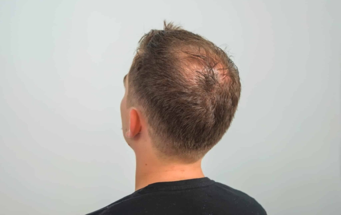 Male Pattern Baldness-Treatments and Solutions