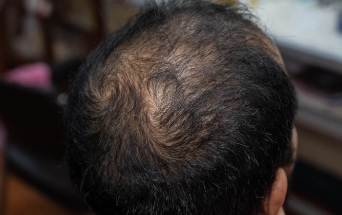 Male Pattern Baldness and PRP