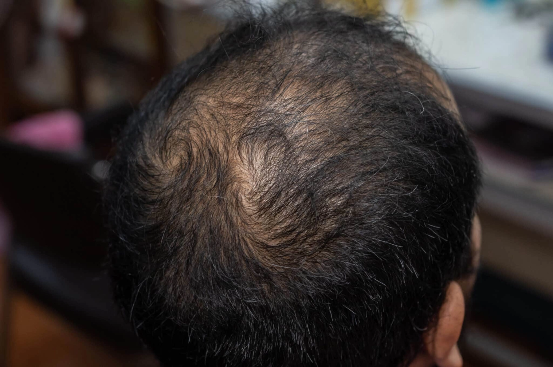 Male Pattern Baldness and PRP