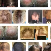 Before And After iRestore laser helmet for hair loss