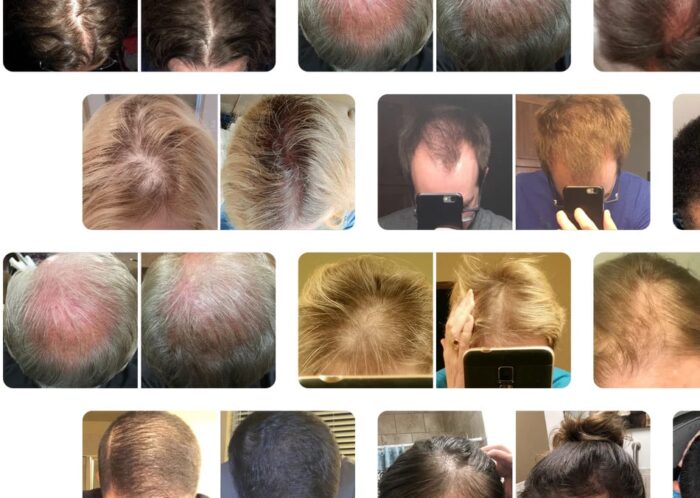 Before And After iRestore laser helmet for hair loss