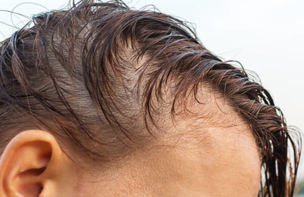 male baldness treatment