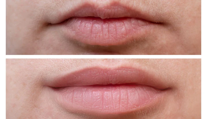 Botox Lip Flip Before And After Photo