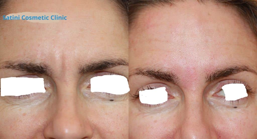 Before And After Botox For Forehead Lines