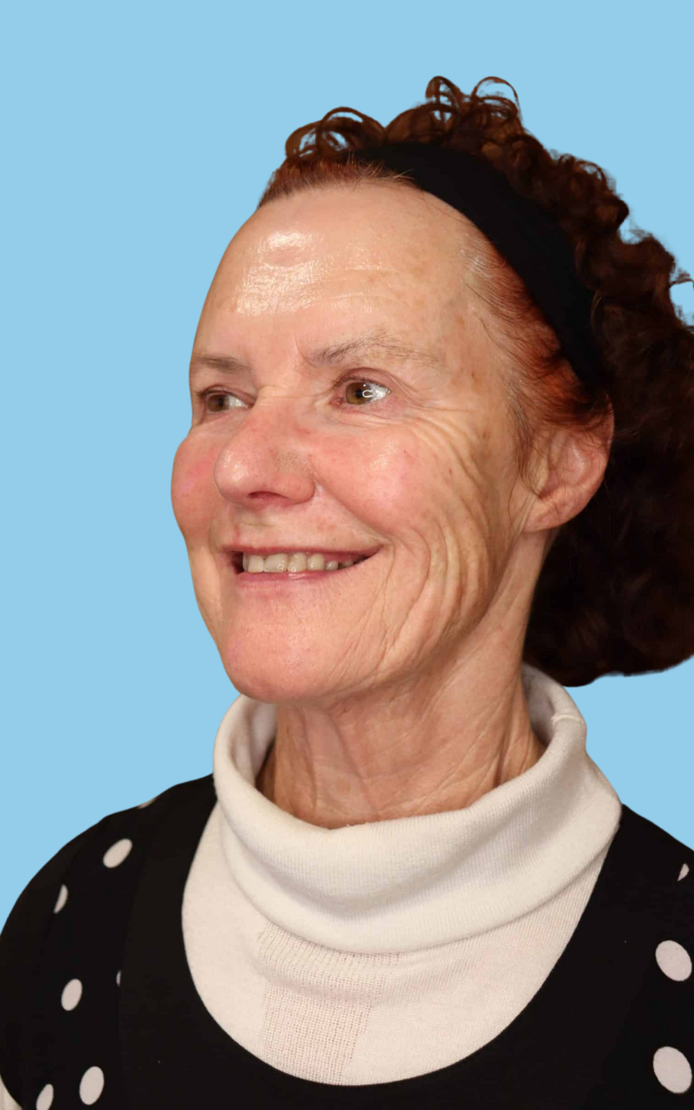 Glenda after dermal filler at Satini Cosmetic Clinic Christchurch