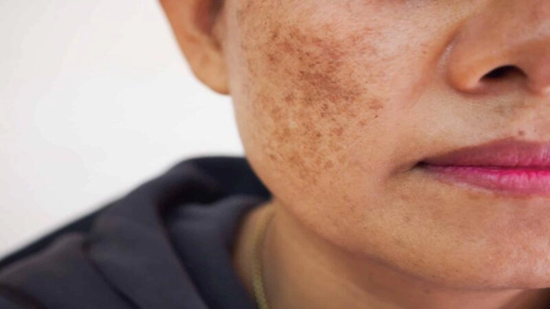 Melasma on face-melasma treatment