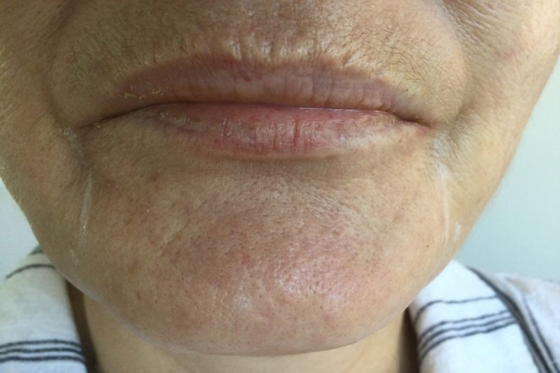 Before Dermal Filler For The Lips