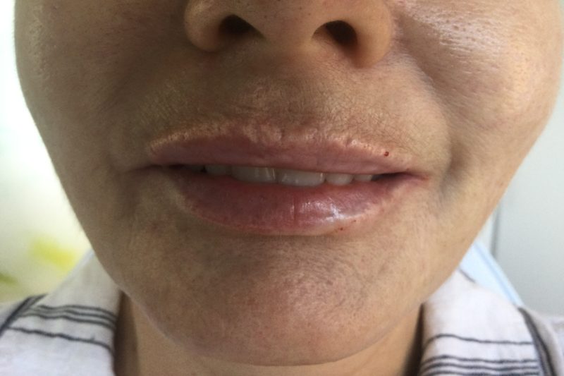 After lip filler