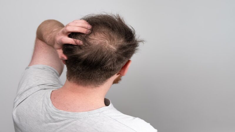 baldness in men-hair clinic near me