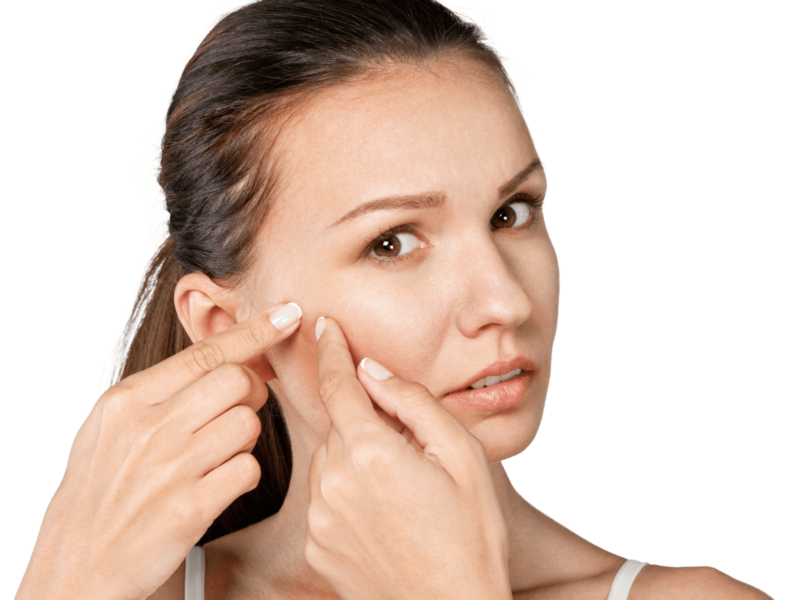 Woman with acne scars