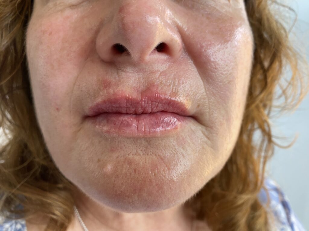 Middle Aged Woman After Lip Fillers