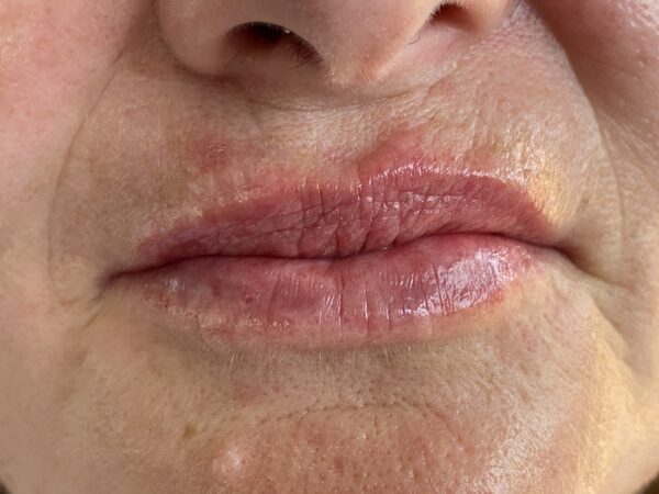 Before And After 1 ml lip filler
