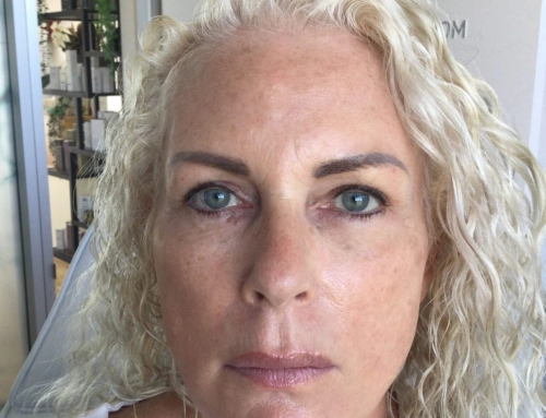 Ingrid’s Story After Non Surgical Facelift