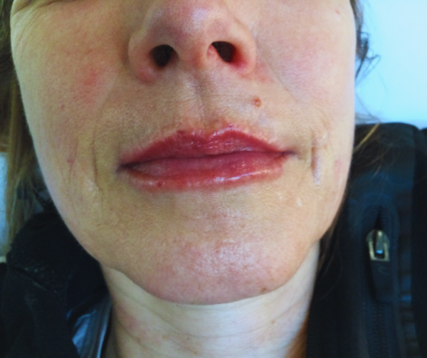 Karen After Dermal Filler For Upper Lip Lines