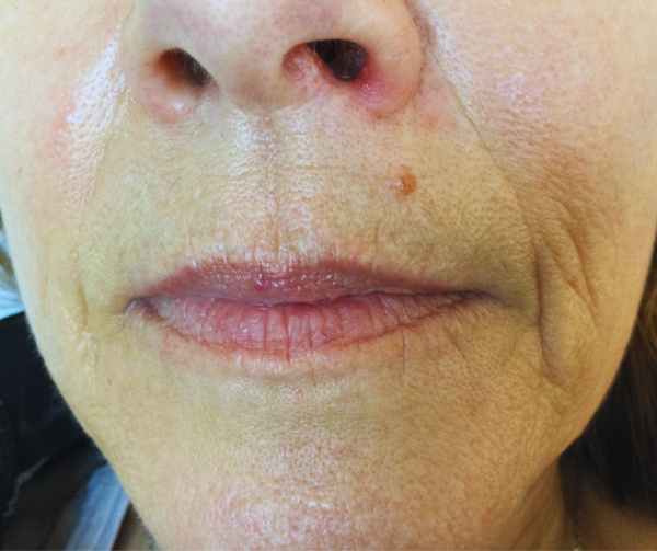 Karen Before Dermal filler for upper lip lines
