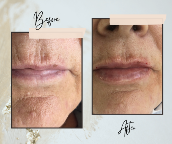 Before and after 1 ml of lip filler
