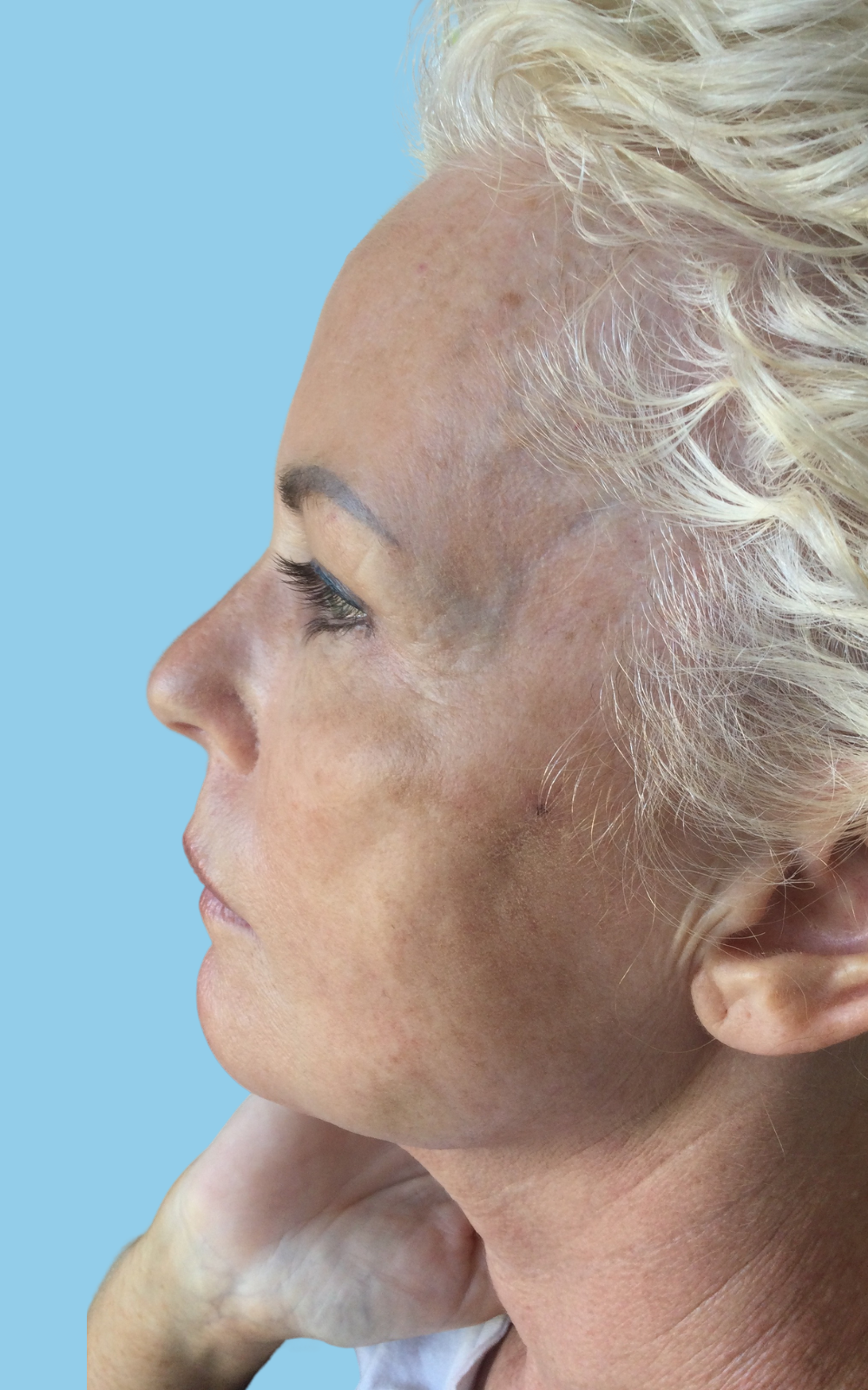 Ingrid After PDO Thread Non Surgical Facelift