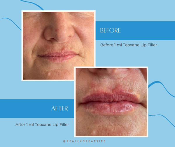Before and after 1 ml lip filler in a 50 year old woman 