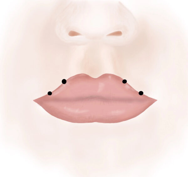 Botox For The Lips-The injection points