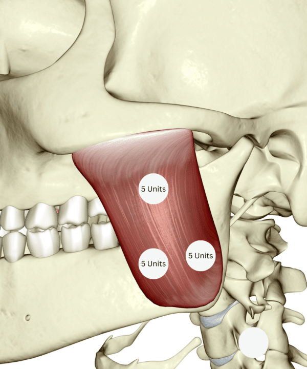 Masseter Botox Injection Points