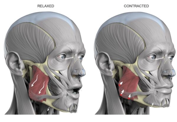 Masseter Muscle Hypertrophy