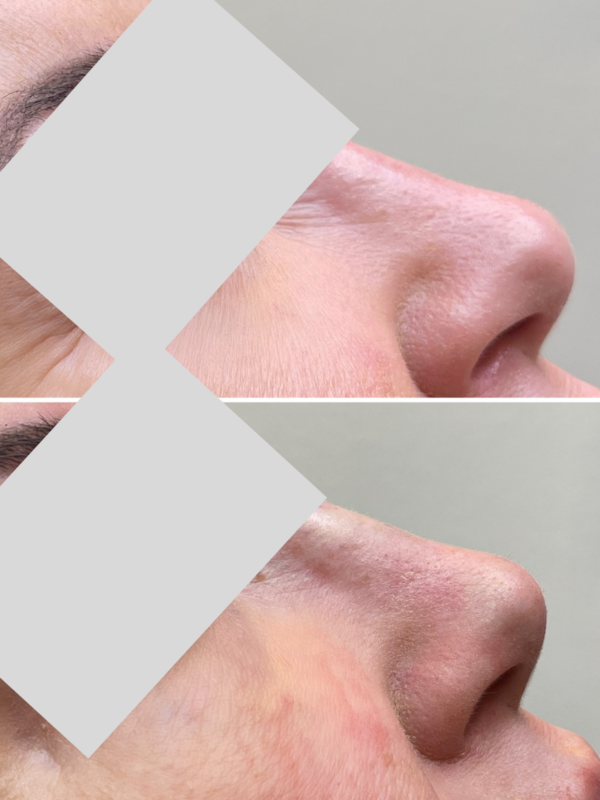 Before and after nose lift with PDO threads