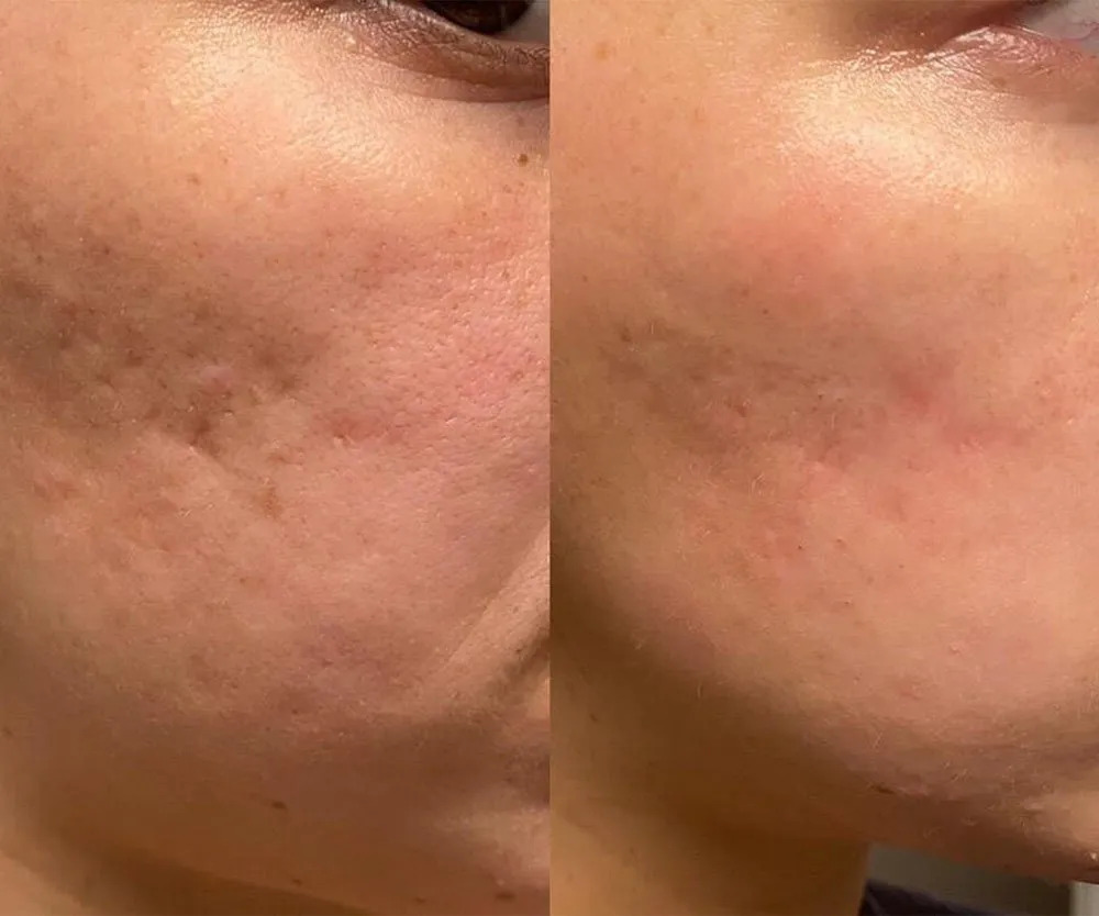 Before and after microneedling for acne scars
