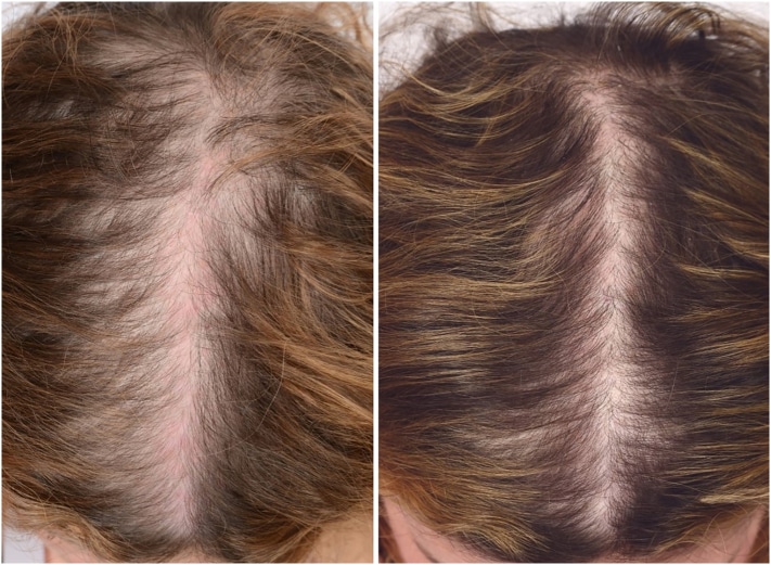 Before and after PRP Plasma for hair loss