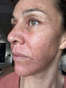 Jessie 2 days after cosmelan peel, redness and swelling of the lower face