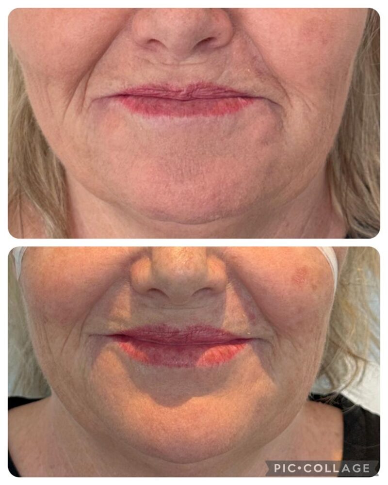Folds between the nose and lips before and after non-surgical facelift, Chrissie