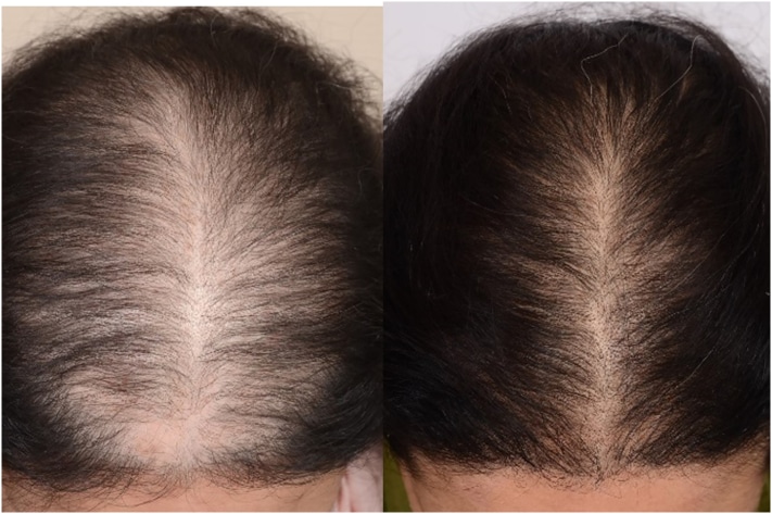 Female before and after PRP Plasma for hair loss