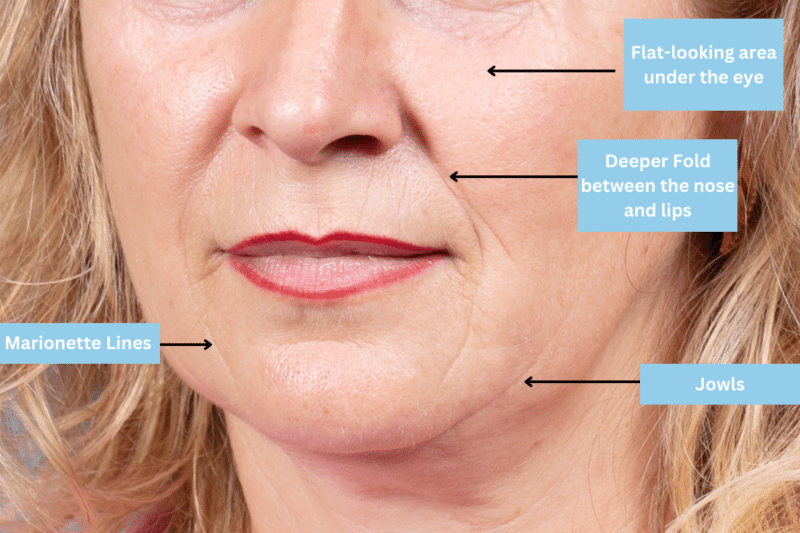 Signs of facial sagging before a facelift