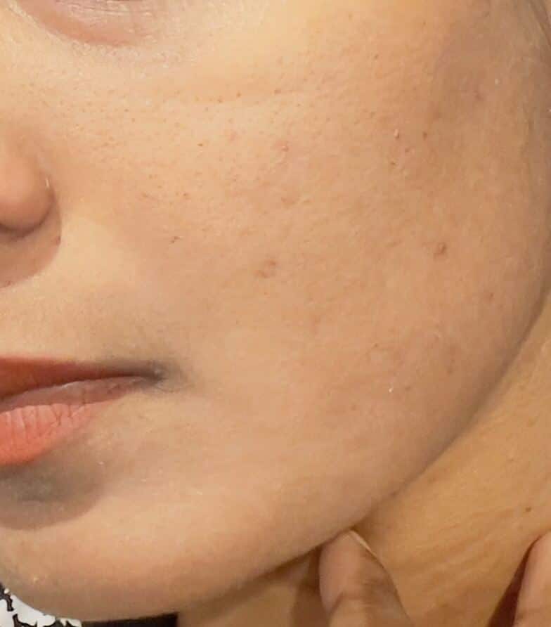 After Glutathione Injections the skin colour is whiter