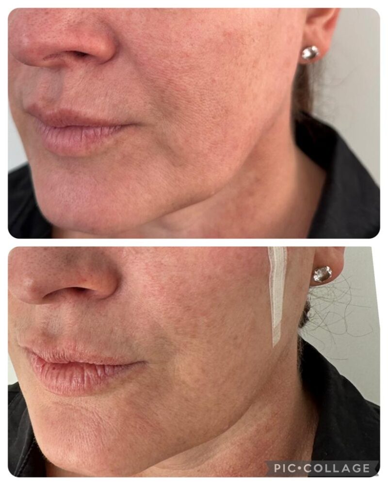 Before And After Non-Surgical Facelift